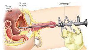 Laparoscopic Appendectomy by Bipolar