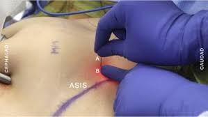 Laparoscopic tubal sterilization