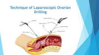 Minimally invasive care for young patients: Laparoscopic appendectomy in pediatric cases