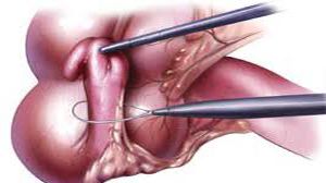 Total Laparoscopic Hysterectomy by Meltzer's Knot