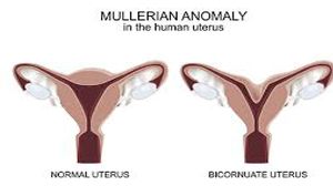 Diagnostic Laparoscopy for Developmental Anomalies of the Müllerian Duct