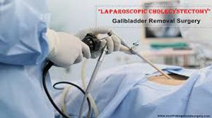 Laparoscopy for Minor Distal Tubal Fimbrial Block