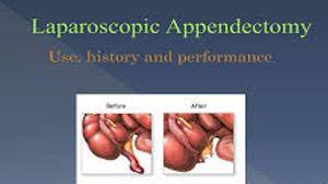 Laparoscopic Appendicectomy by Dr R K Mishra