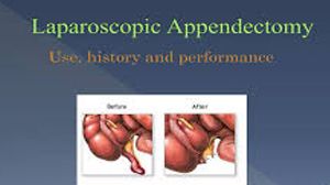 Ovarian Endometrioma Ablation for Preservation of the Ovarian Parenchyma