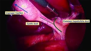 Laparoscopic Hand Instrument Demonstration Part 3 by Dr R K Mishra