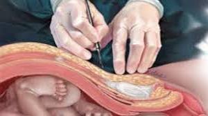 Laparoscopic Appendectomy by Bipolar