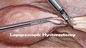 Laparoscopic Surgery for Hydatid Cyst Disease