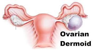 Laparoscopic Ovarian Cystectomy for Right Sided Dermoid Cyst