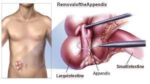 Laparoscopic Myomectomy with Baseball Suturing