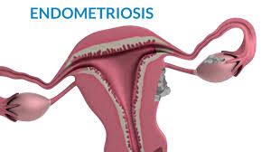 Laparoscopic Management of Bilateral Endometrioma with Pelvic Adhesion