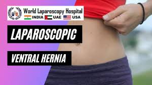 Laparoscopic Ventral Hernia repair by Dr R K Mishra