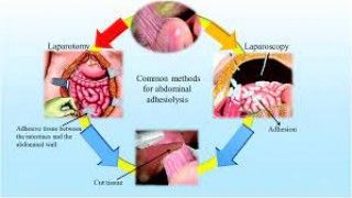 Laparoscopic Sterilization Lecture by Dr R K Mishra