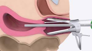 Hysteroscopy