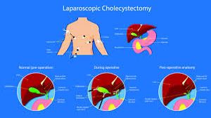 Laparoscopic oophorectomy in 3 year old child