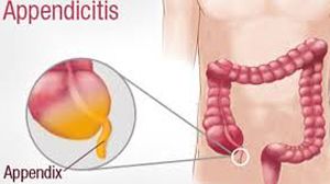 da Vinci Robotic Gastrojejunostomy during Gastric Bypass