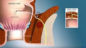 Laparoscopic Choledocotomy Lecture by Dr R K Mishra