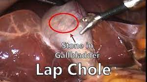 Robotic Cholecystectomy for Empyema Gallbladder