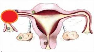 Total Laparoscopic Hysterectomy