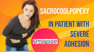 Sacrocolpopexy in patient with severe adhesion