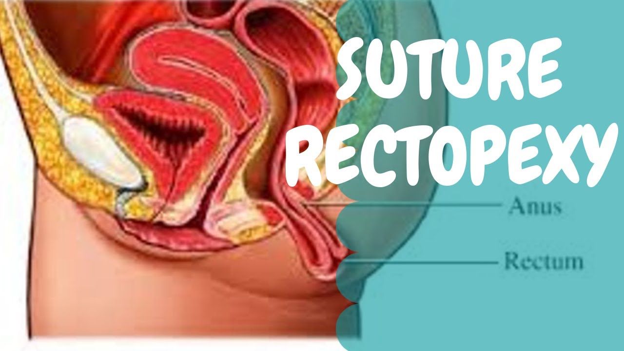 Suture Rectopexy for Rectal Prolapse