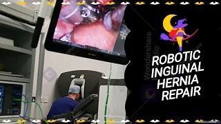 Laparoscopic Appendectomy for Acute Appendicitis (Retrocecal Appendix)