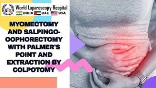 Laparoscopic Myomectomy with Baseball Suturing