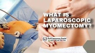 What is Laparoscopic Myomectomy?
