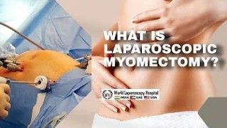 Laparoscopic Removal of Large Subserous Fibroid