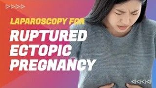 Ruptured Ectopic Pregnancy