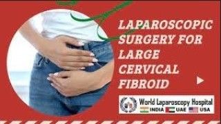 Laparoscopic Removal of Large Posterior Cervical Fibroid