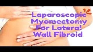 Laparoscopic Myomectomy Lateral Wall Fibroid Uterus