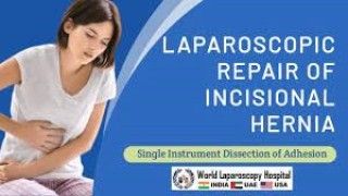 Laparoscopic oophorectomy in 3 year old child