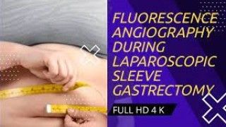Fluorescence Angiography During Laparoscopic Sleeve Gastrectomy