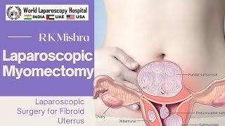 Laparoscopic Surgery for Large Intramural Fibroid Uterus