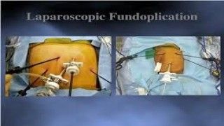 Laparoscopic Myomectomy and Salpingo-oophorectomy with Palmer's Point and Extraction by Colpotomy