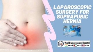 Laparoscopic Disposable Trocars