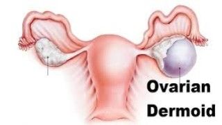 Ovarian cystectomy for Right Ovarian Cyst