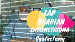 Laparoscopic Ovarian Cystectomy for Endometrioma