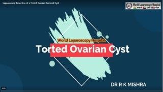 Bilateral Dermoid Cyst