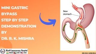 Laparoscopic Management of Ventral Hernia