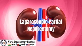 Laparoscopic Myomectomy with Baseball Suturing