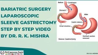 Laparoscopic Myomectomy with Baseball Suturing