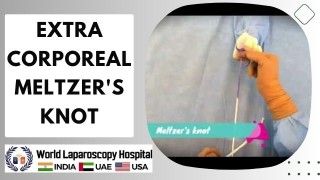 Laparoscopic Cholecystectomy Full Length Skin to Skin Video with Near Infrared Cholangiography