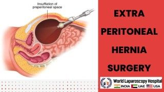 Total laparoscopic hysterectomy (TLH) in patients with previous cesarean section