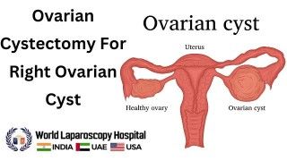 Laparoscopic Myomectomy for Intramural Fibroid