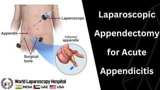 Laparoscopic Appendectomy for Acute Appendicitis