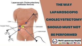 Laparoscopic Repair of Vental Hernia Lecture by Dr R K Mishra