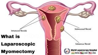 Laparoscopic Cholecystectomy Full Length Skin to Skin Video with Near Infrared Cholangiography