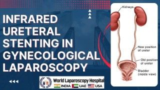 Laparoscopic Ovarian Cystectomy: Minimally Invasive Removal of Dermoid Cysts