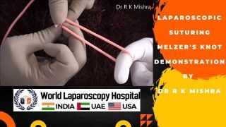 Laparoscopic Myomectomy for Large Uterine Fibroid